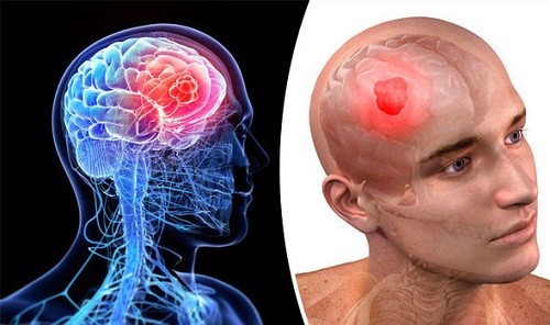 سر درد| درمان تومور مغزی